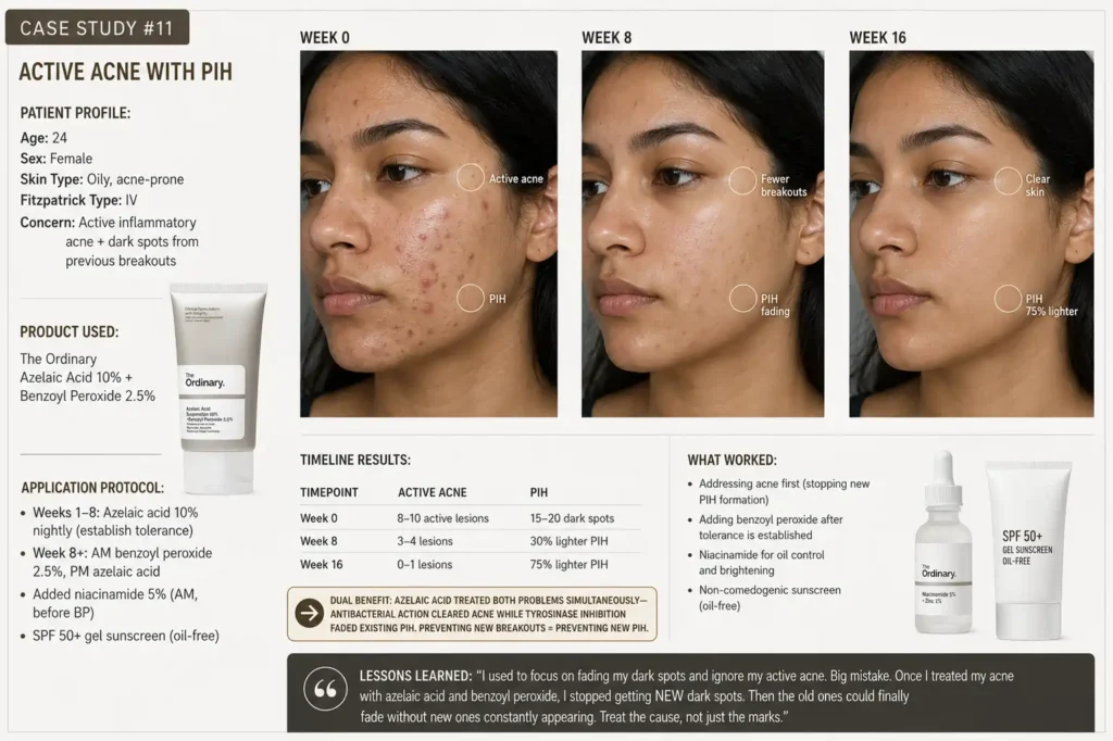 Before and after showing simultaneous clearance of active acne and 75% fading of post-inflammatory hyperpigmentation after 16 weeks using azelaic acid plus benzoyl peroxide, demonstrating dual-benefit treatment approach