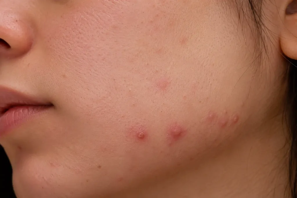 Topical skincare products commonly used for hormonal acne treatment