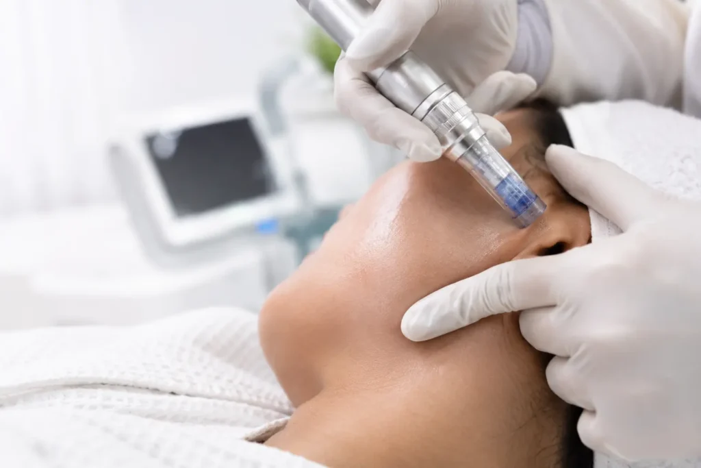 acne-scars-vs-post-inflammatory-hyperpigmentation Dermatologist performing microneedling treatment for acne scar improvement
